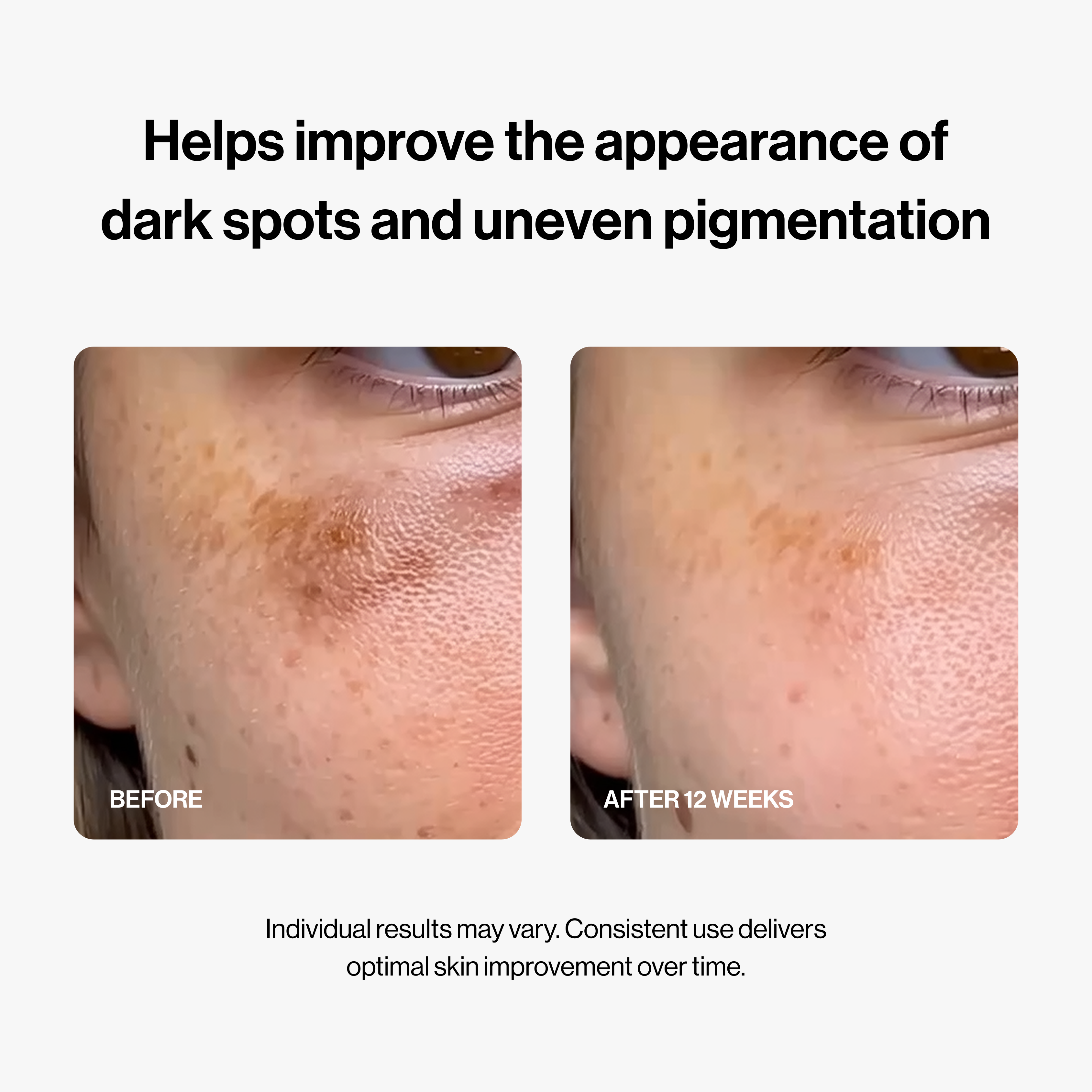 PDRN Micro-Infusion System