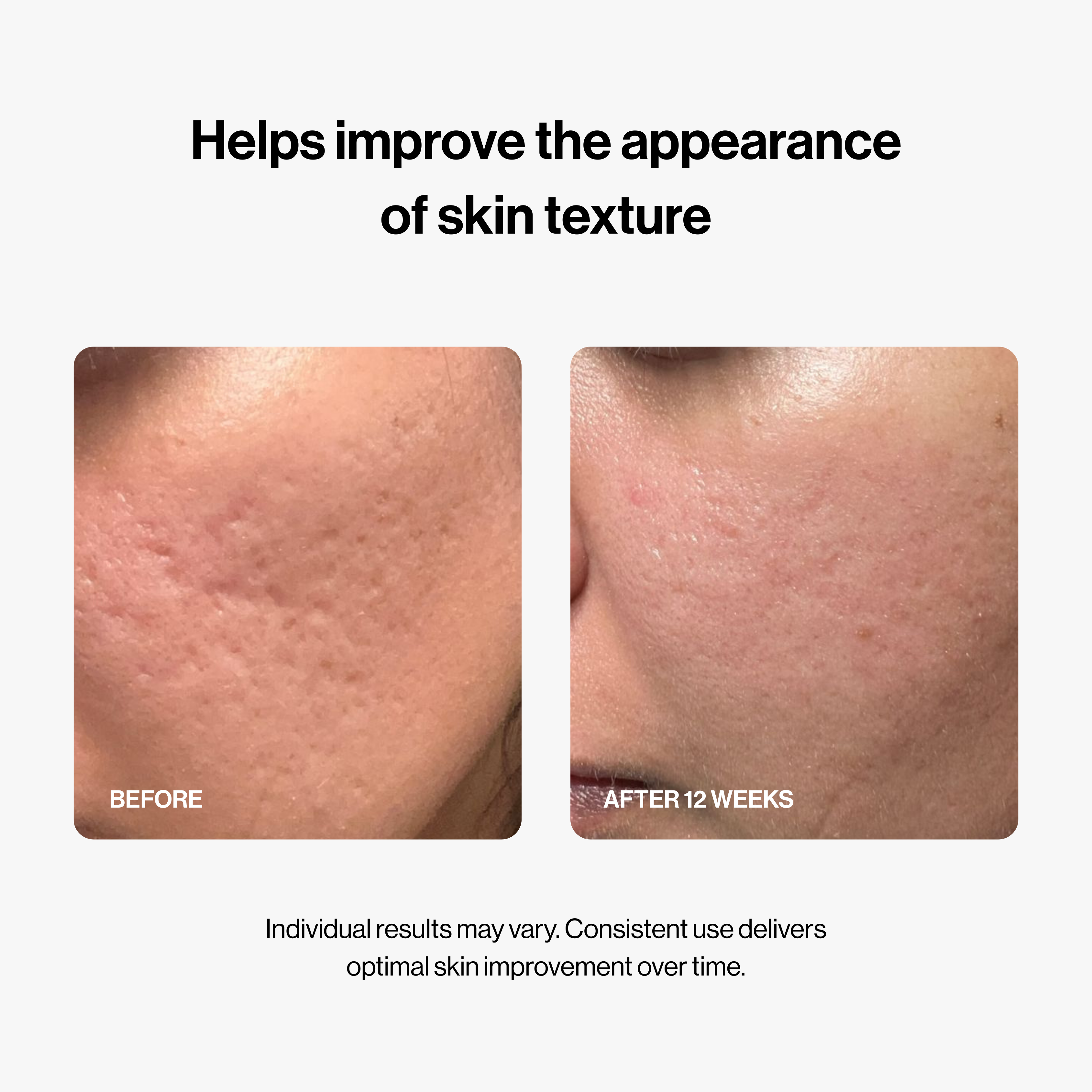 PDRN Micro-Infusion System