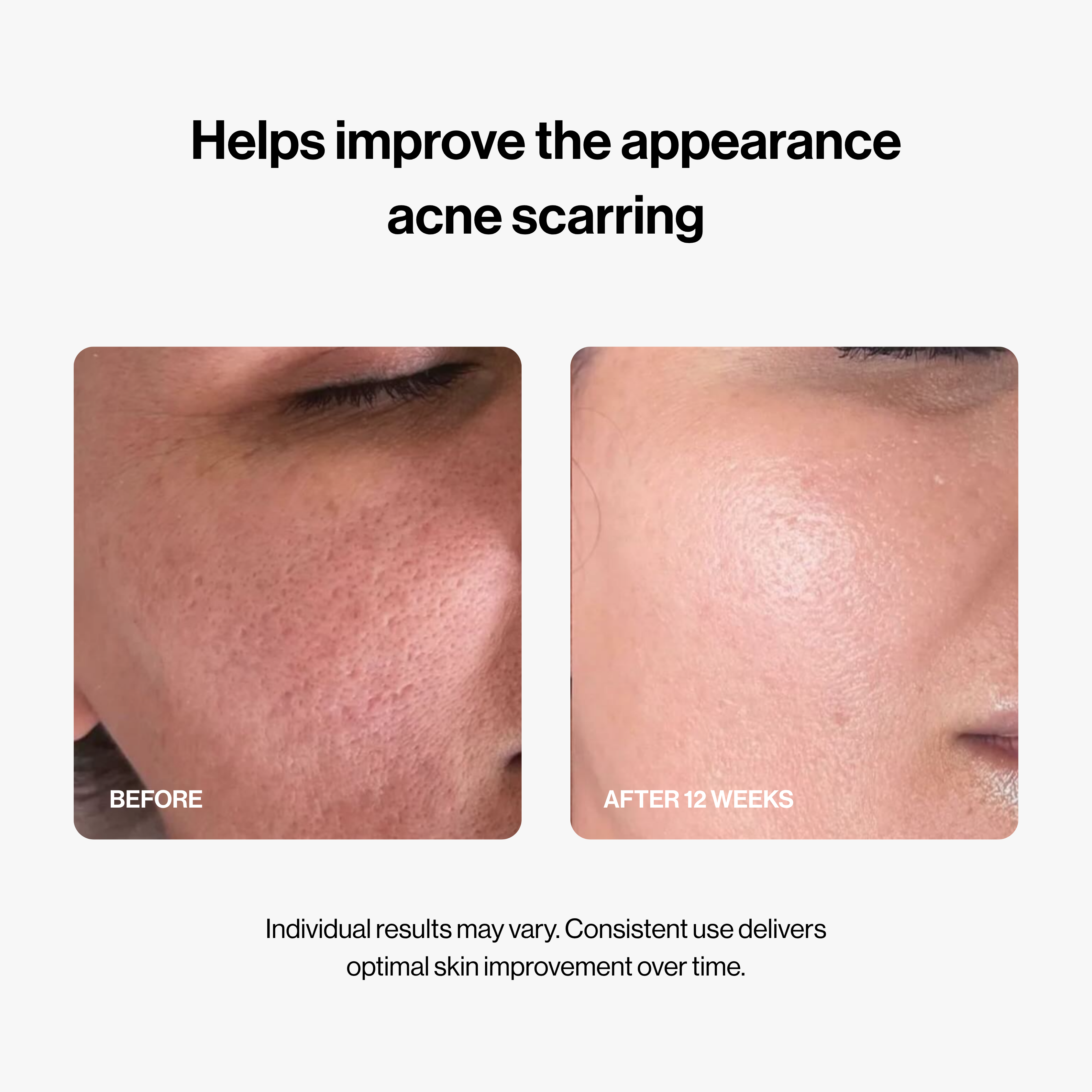 PDRN Micro-Infusion System