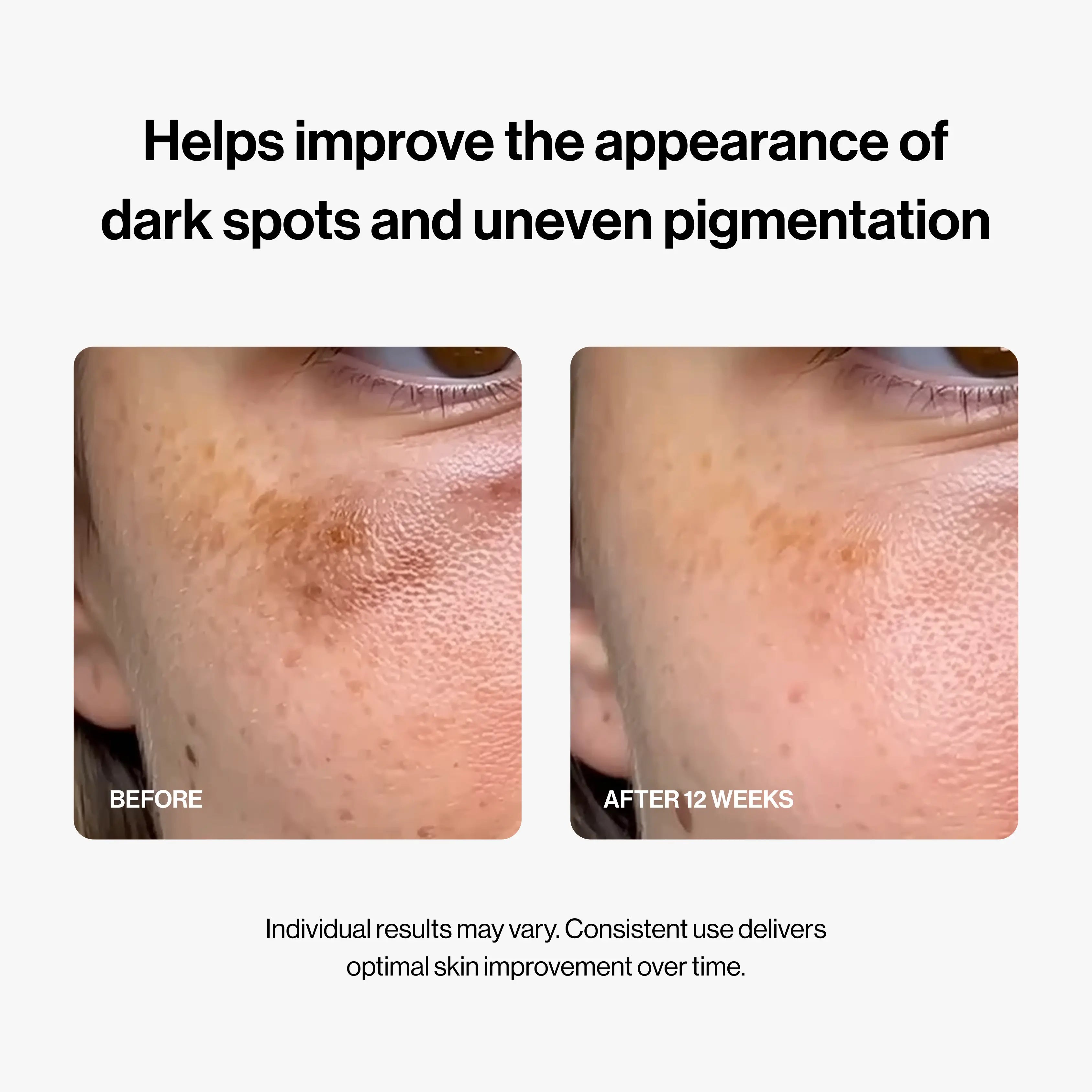 PDRN Micro-Infusion System SkinOS